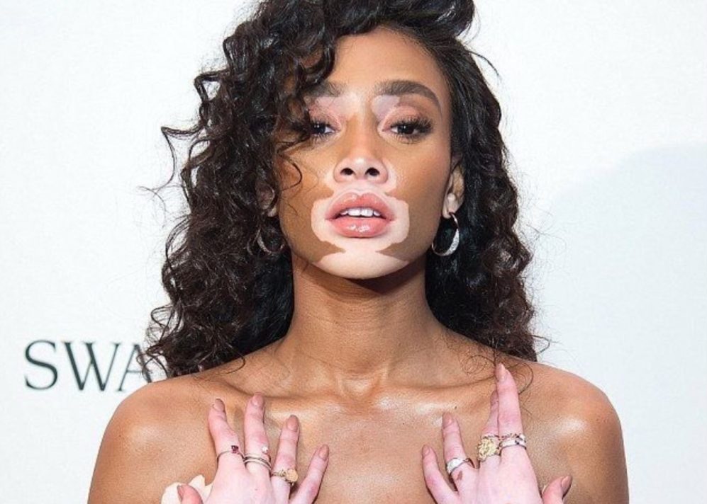 Winnie Harlow est atteinte de vitiligo