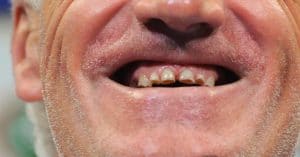 Un grand footballeur avait des dents horribles et il a dépensé une somme hallucinante pour refaire ses dents !